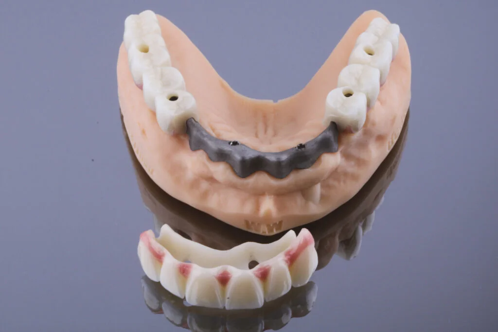 Restoratif Sanat ve Biyomekanik Hassasiyet: Tam Çene Rehabilitasyonunda Segmental Yaklaşım 3
