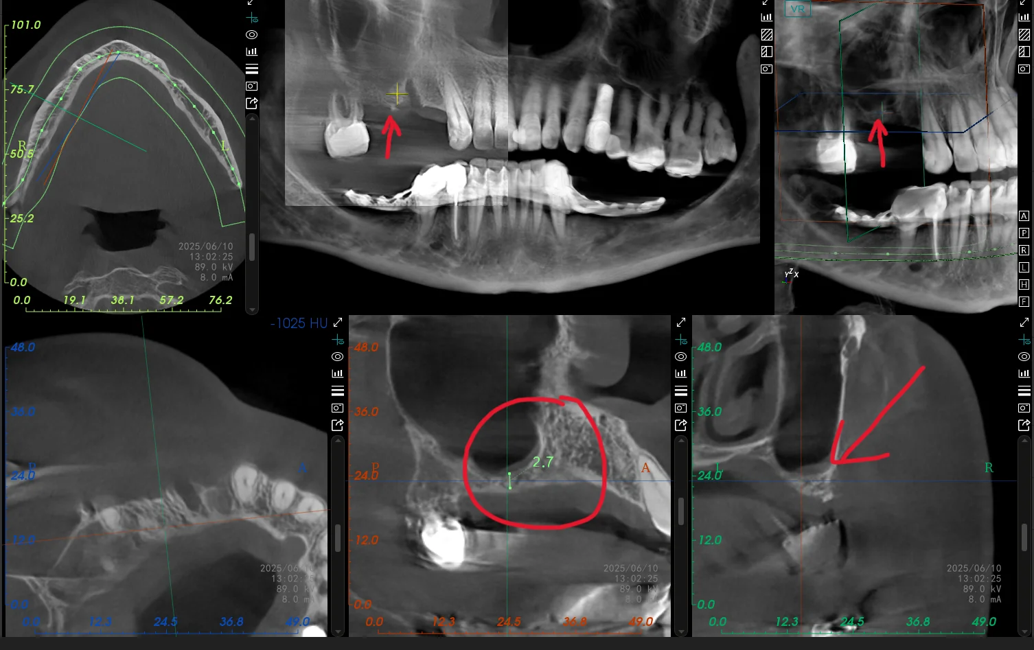Tedavi öncesi kemik yetersizliklerini gösteren 3D tomografi görüntüleri