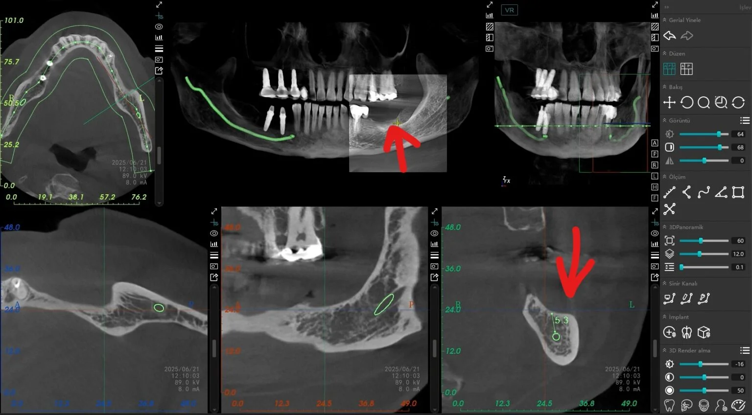 Cerrahi Öncesi Kemik Yetersizliğini Gösteren Tomografi Görüntüsü