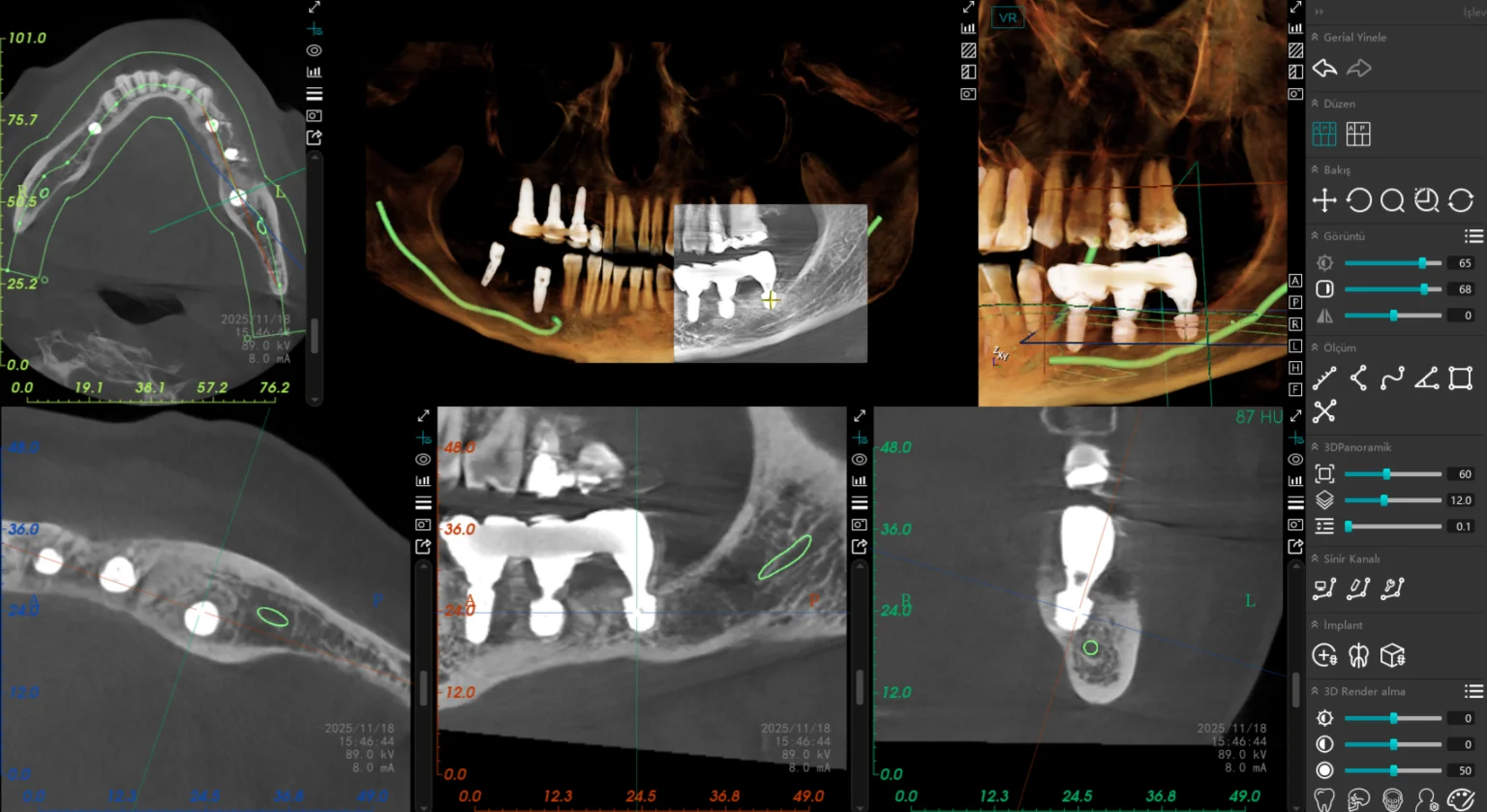 Short İmplant Final Bitim Tomografisi