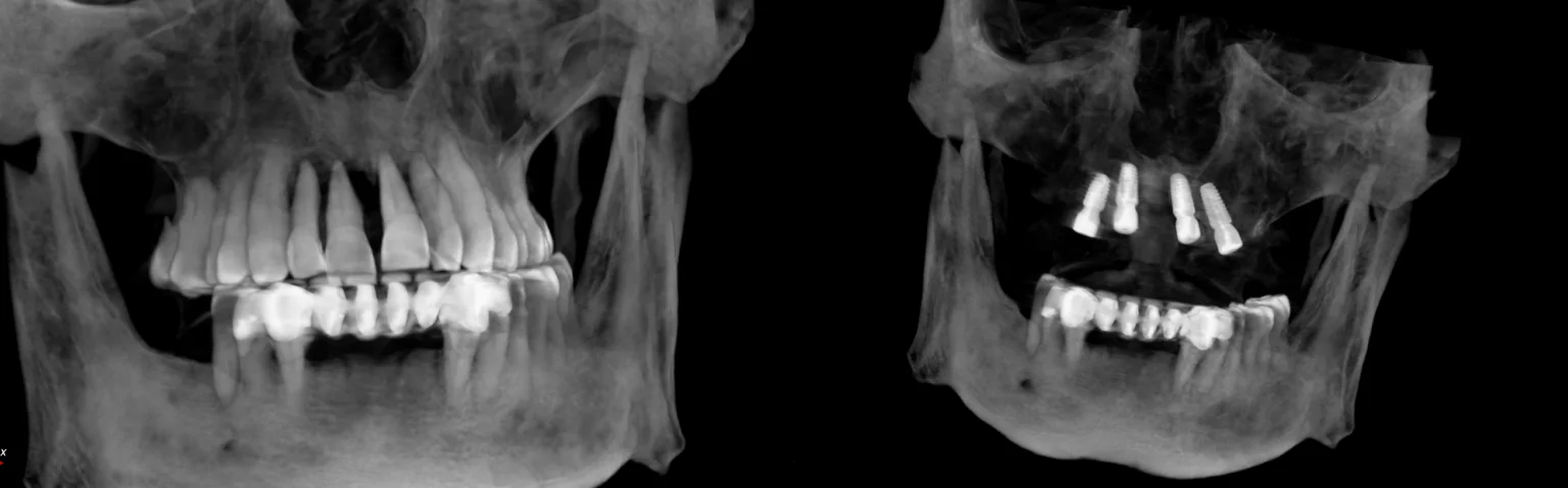 İyileşme süreci tamamlandıktan sonra tamamen dijital bir iş akışı kurguladım. Hastamızın CBCT verileri ile ağız içi tarayıcıdan aldığımız dijital ölçüleri bilgisayar ortamında çakıştırdım. Guided Cerrahi (Rehberli Cerrahi) planlamasıyla implantların konumlarını, kemiğin en kaliteli olduğu noktalara göre milimetrik olarak belirledim. Planladığımız cerrahi rehber eşliğinde operasyonu gerçekleştirdim. Bu yöntemin sağladığı hassasiyet, sadece cerrahi aşamada değil, protez aşamasında da büyük avantaj sağladı. Protez tasarım ve üretim süreçlerini de tamamen dijital tekniklerle yürüterek, ağız içi taramalar sayesinde geleneksel ölçü yöntemlerinin yarattığı konforsuzluğu ortadan kaldırdım. Hem cerrahi hem de protez aşamasındaki bu dijital entegrasyon, hata payını minimize ederek biyomekanik açıdan kusursuz bir uyum sağladı.