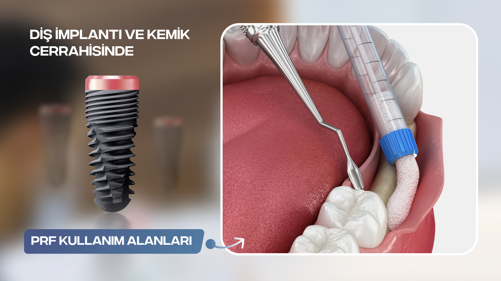 PRF Nedir? Diş İmplantı ve Kemik Cerrahisinde PRF Kullanımı